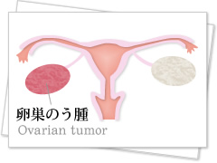 卵巣 の う 腫