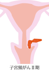 子宮頸がんⅡ期