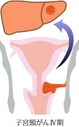 子宮頸がんⅣ期