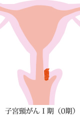 子宮頸がんⅠ期（0期）