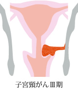 子宮頸がんⅢ期